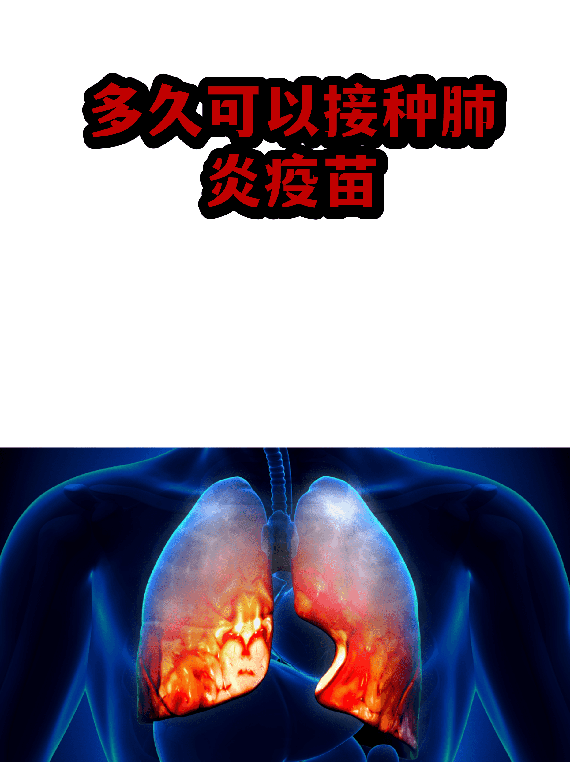 陕西肺炎〃陕西肺炎疫苗多少钱一针
